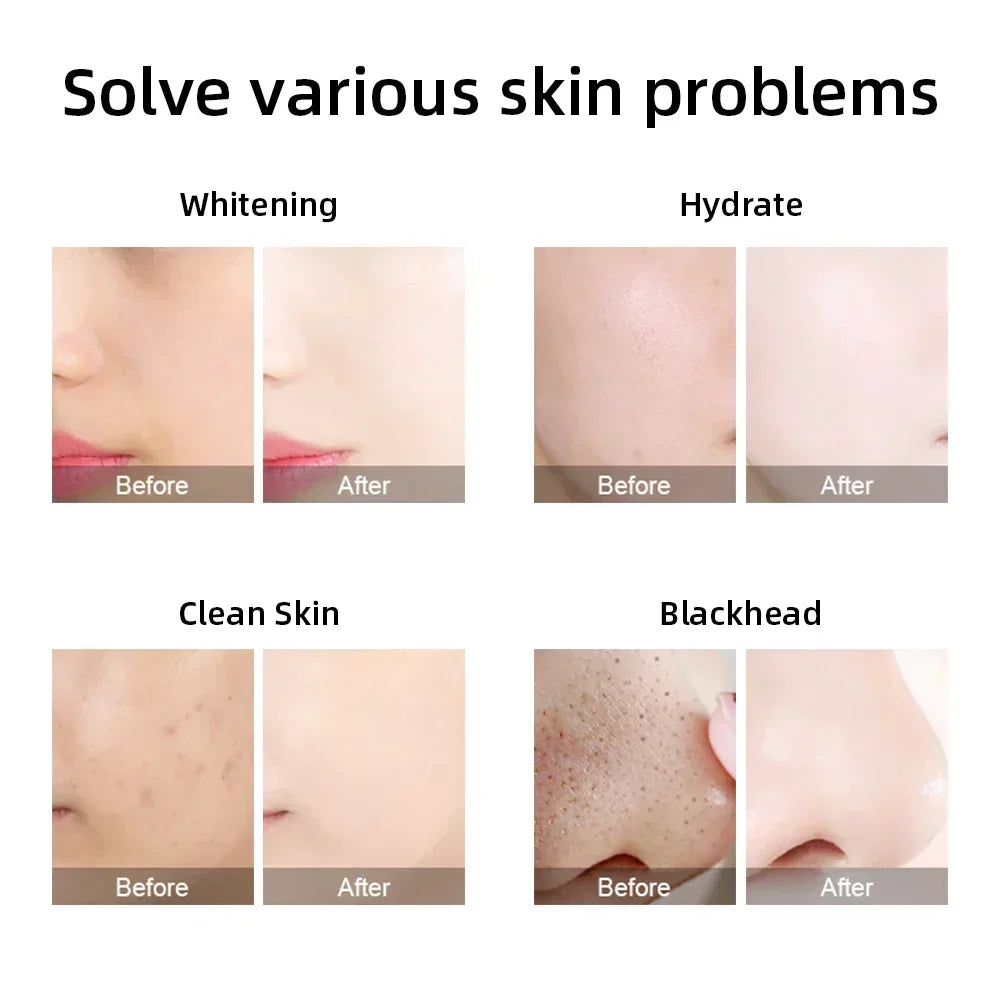 ⚡ Skin Detox Revolution: Missheart Pro-Hydra Facial Deep Cleaning Machine ⚡